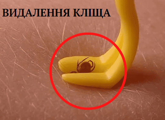 Видалення кліща в домашніх умовах за допомогою пристроя для видалення кліщів